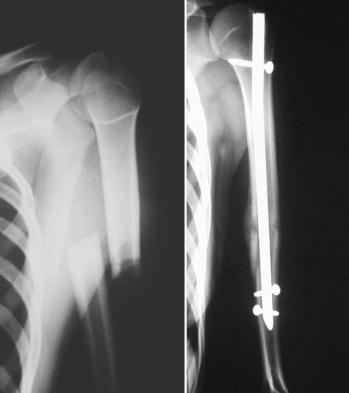 a. RTG obraz zlomeniny diafýzy pažní kosti
Pic. 3a. X-ray picture of the humeral shaft fracture
b. RTG obraz zhojené zlomeniny pažní kosti po nitrodřeňové osteosyntéze antegrádně zavedeným zajištěným hřebem UHN
Obr. 3b. X-ray picture of the healed humeral shaft fractures after intramedullar osteosynthesis by antegrade unreamed humeral nail