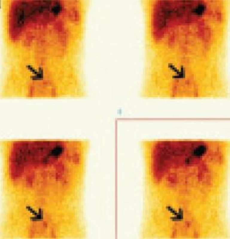Dynamická scintigrafie dutiny břišní u 24letého muže s enteroragií. Sumace dynamických scintigramů po 4 minutách. Akumulace &lt;sup&gt;99m&lt;/sup&gt;Tc-pertechnetátu v ektopické žaludeční sliznici v Meckelově divertiklu v horním hypogastriu vlevo od střední čáry pod bifurkací aorty.