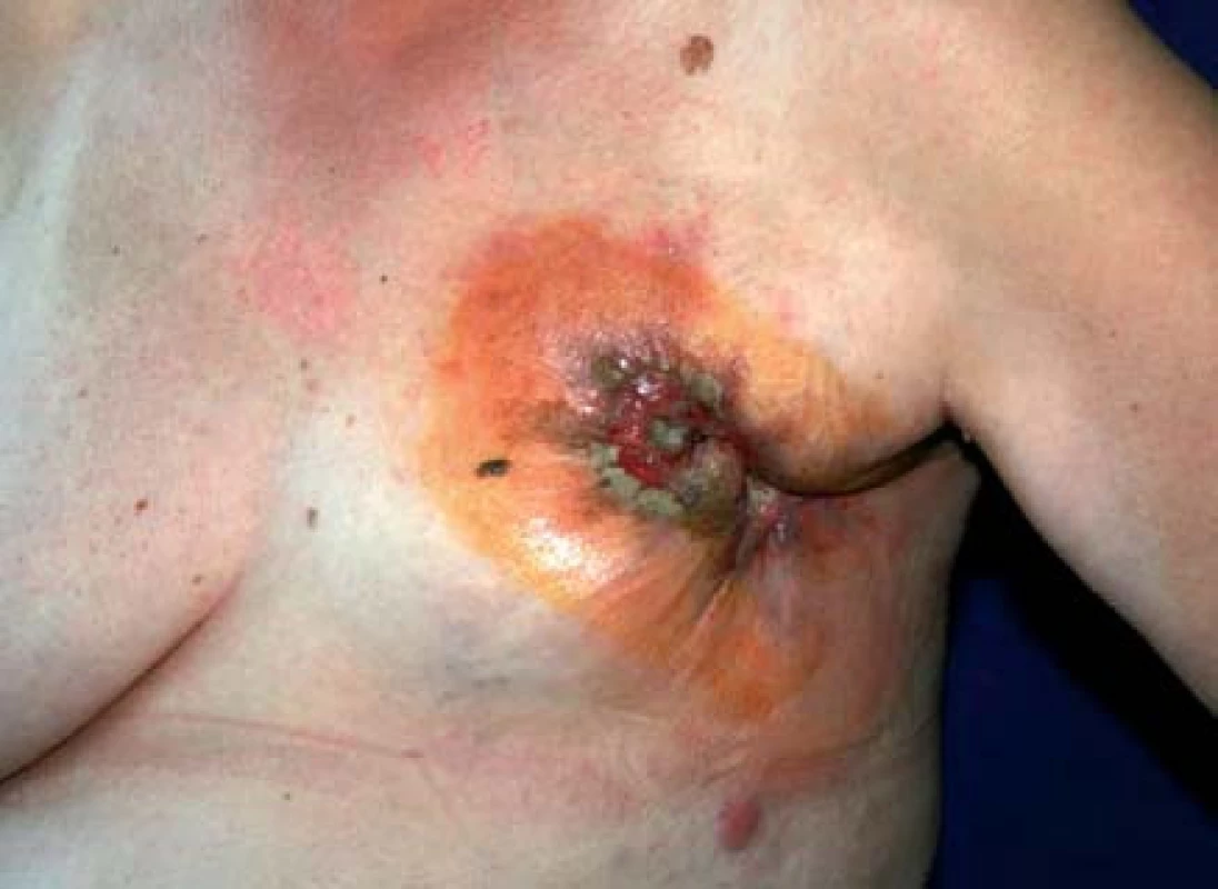 Lokálně pokročilý karcinom – ulkus zcela znetvořující prs, kaudálně od něj satelitní kožní uzel.