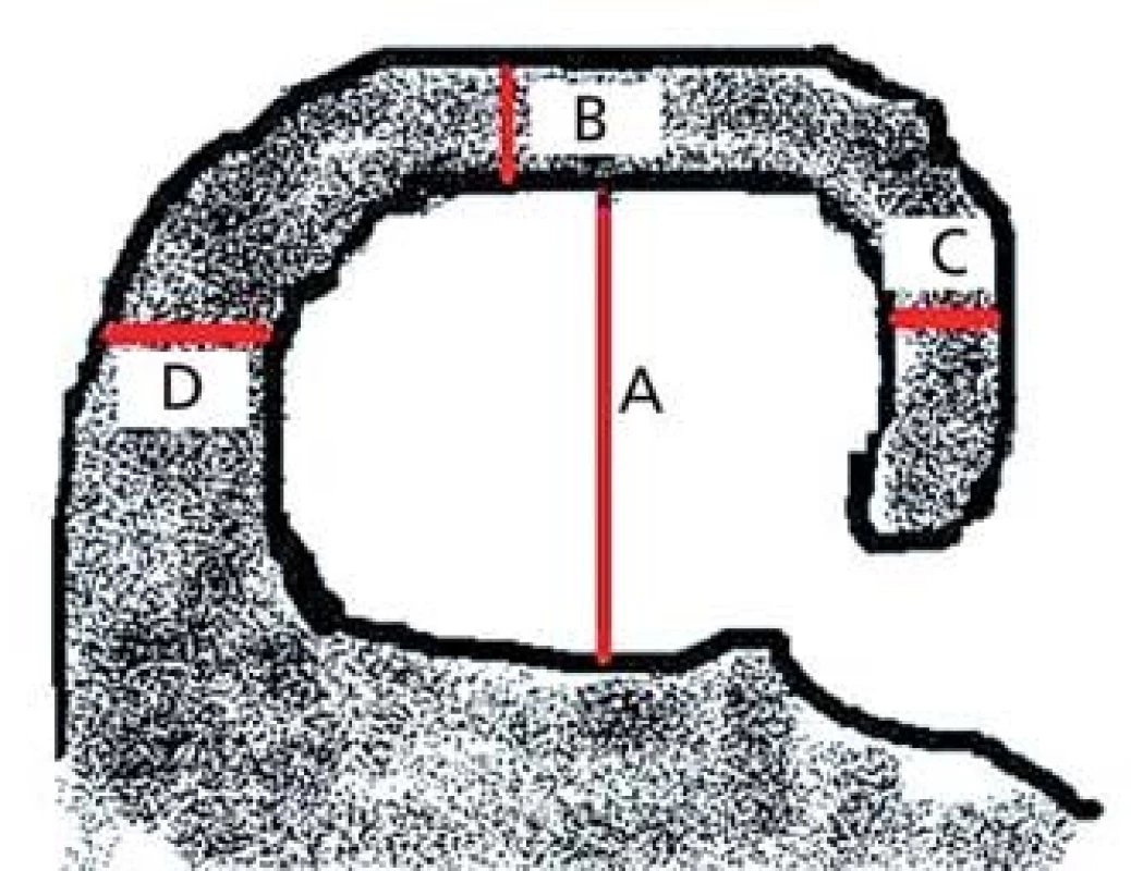 Schéma koronálního řezu hipokampem v úrovni předního pontu. Výška hipokampu (A), šířka choroidální štěrbiny (B), šířka temporálního rohu (C), vzdálenost mezi mozkovým kmenem a hipokampem (D – nehodnotí se).
