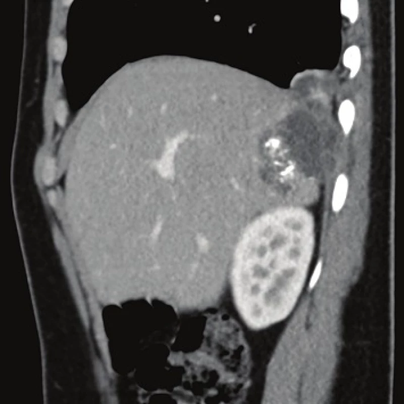 Contrast enhanced CT, venous phase, sagittal plane: the relationship between the lesion, diaphragm and lung.