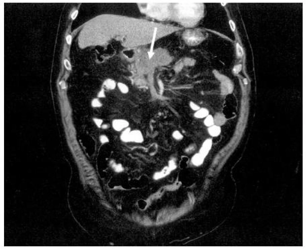 CT obraz nádoru hlavy pankreatu infiltrující oblast confluens (↑)