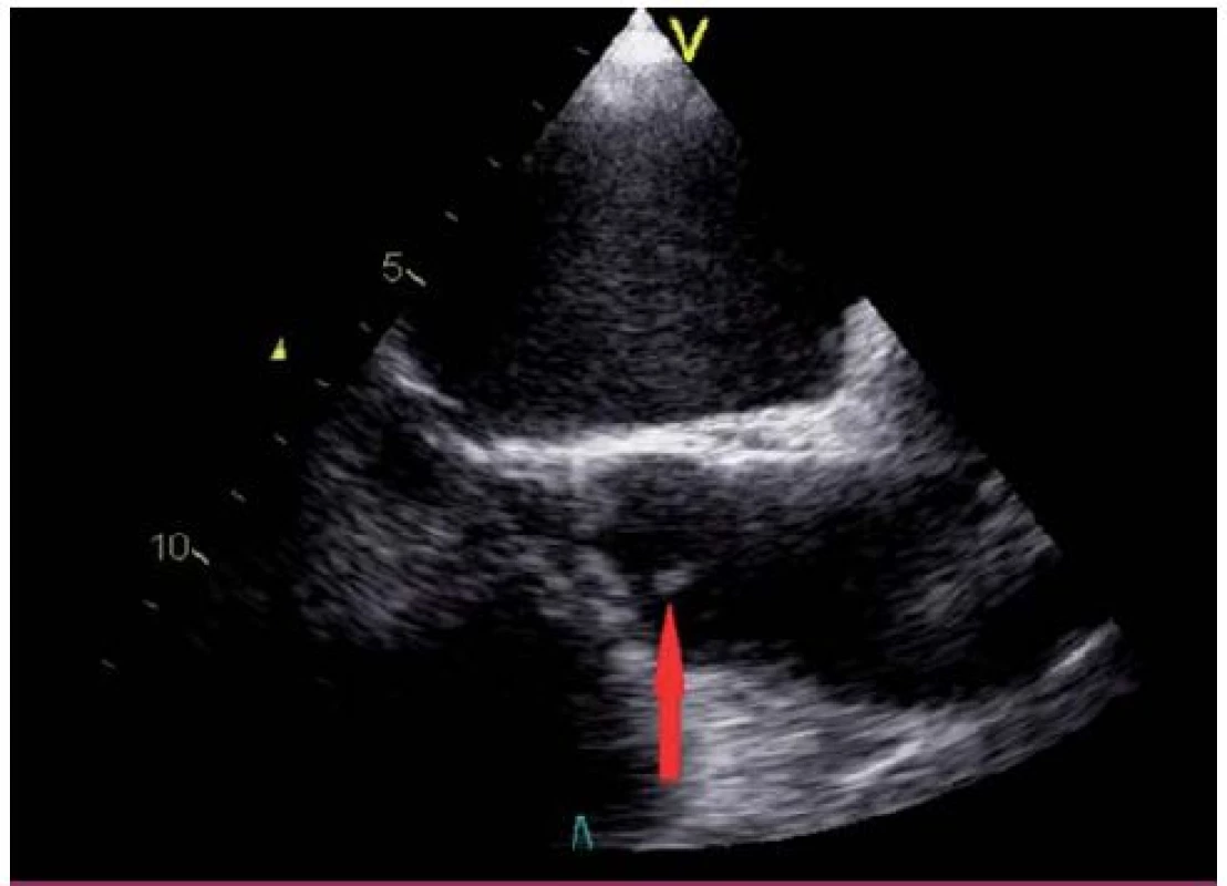 Lamblova ekrescence na nekoronárním cípu aortální chlopně (transesofageální echokardiografie – projekce na dlouhou osu levé komory).