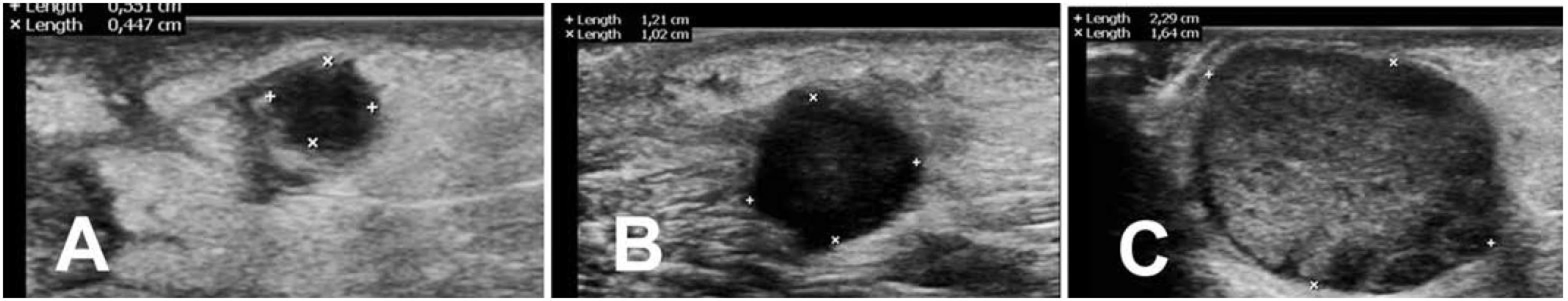 Ultrazvukové vyšetření podkožní metastázy podléhající „pseudoprogresi“ a ve 4., B v 8. a C ve 12. týdnu