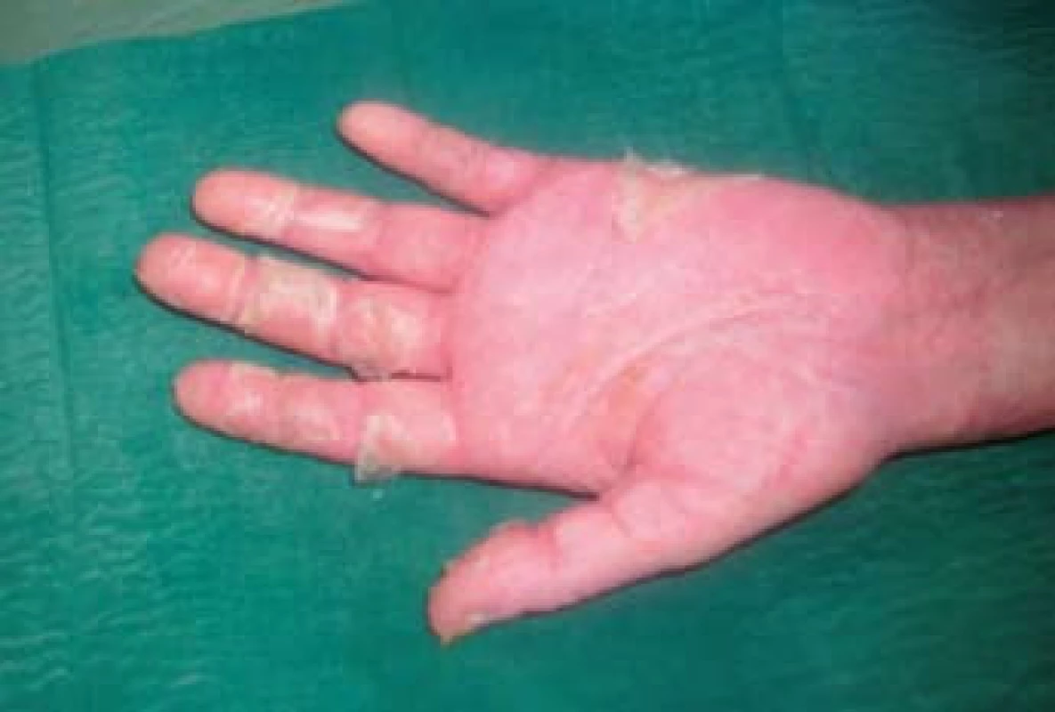Olupující se exantém na dlaních.
Fig. 4. Peeling exanthem on the palms.