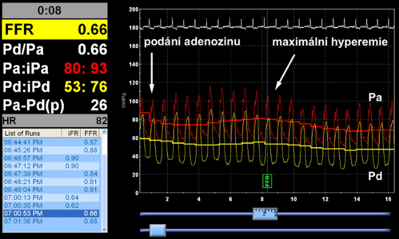Záznam měření po intrakoronárním podání adenosinu. Hodnota FFR 0.66, ale i nízký poměr klidových tlaků Pd/Pa ještě před navozením hyperemie svědčí pro jasně významnou stenózu.