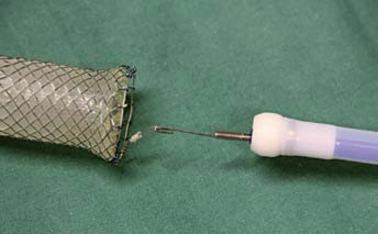 Stent s očkem vývazového lanka pro extrakci zachyceným do extraktoru.
Fig. 12. Stent with a loop of an unbinding cable for extraction, attached to the extractor.