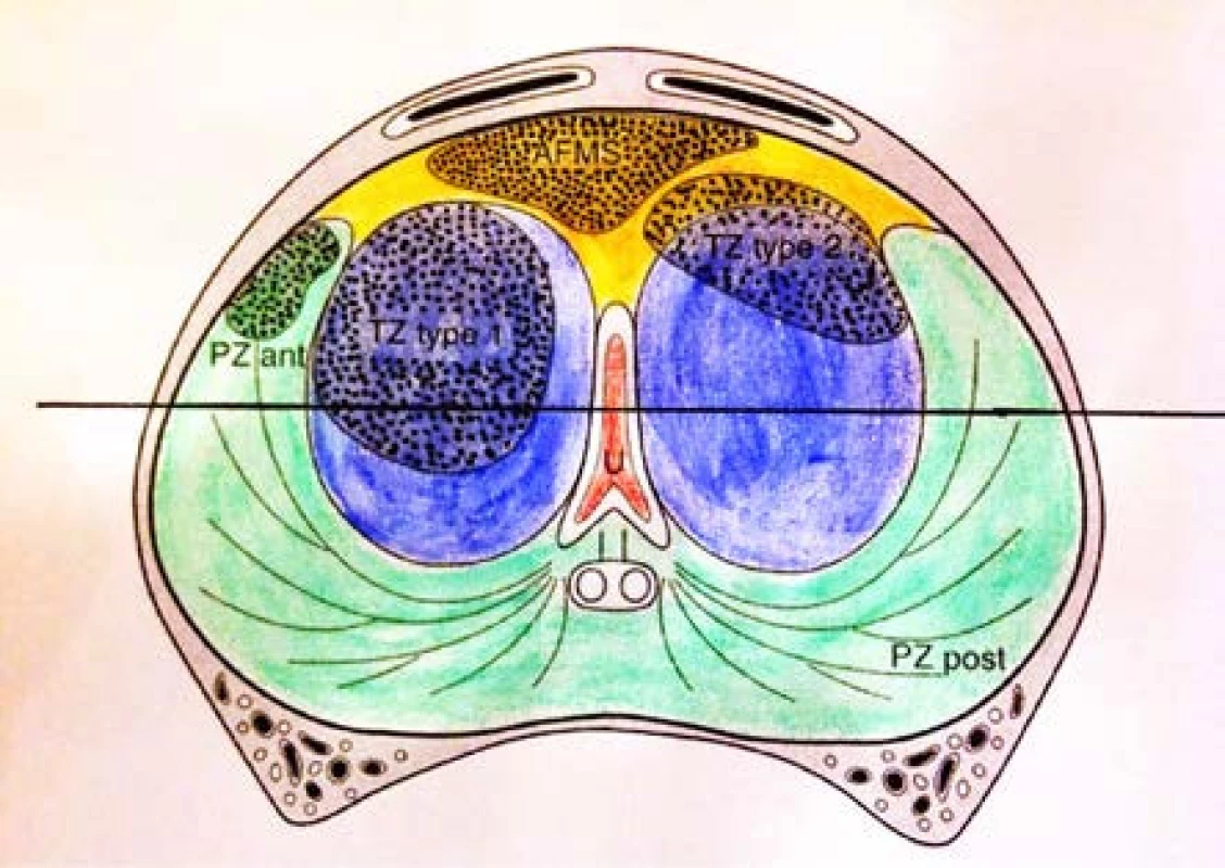 Schéma výskytu anteriorních tumorů. PZ post – periferní zóna posteriorně. PZ ant – anteriorní rohy periferní zóny. TZ type 1 – tranzitorní zóna 1 typu – v jednom laloku tranzitorní zóny. TZ type 2 – tranzitorní zóna 2. typu – většinou v anterolaterální lokalizaci. AFMS – anteriorní fibromuskulární stroma.
Upraveno dle : Lemaitre L, et al. Dynamic contrast-enhanced MRI of anterior prostate cancer: morphometric assessment and correlation with radical prostatectomy findings. Eur Radiol 2009; 19: 470–480
Fig. 1. Definition of the location of prostate cancer. PZ post: posterior peripheral zone. PZ ant: anterolateral peripheral zone (PZ) horn. TZ type 1: within one transitional zone (TZ) lobe. TZ type 2: mostly at anterolateral location or astride the TZ-AFMS boundary. AFMS: anterior fibromuscular stroma. 
References: Lemaitre L, et al. Dynamic contrast-enhanced MRI of anterior prostate cancer: morphometric assessment and correlation with radical prostatectomy findings. Eur Radiol 2009; 19: 470–480