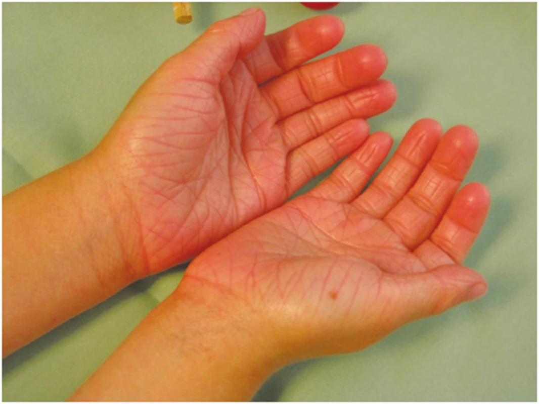 Ichthyosis vulgaris – hyperlinearita dlaní