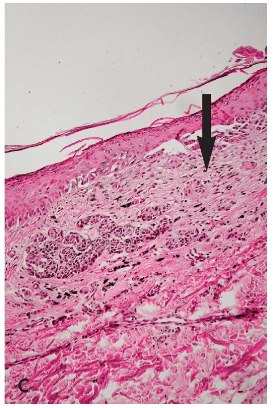 Obr. 5. SAMPUS (superficial atypical melanocytic proliferations of unknown significance). Oválná, symetrická pigmentovaná makula s depigmentací v horním pólu (A – klinický obraz). V dermatoskopickém obrazu ukazuje několik bezstrukturních bělavých okrsků (B – šipka), které histologicky korespondují s ložisky subepidermální plošné fibrózy (C – šipka). Jde o dermoepidermální superficiální melanocytární lézi, která se ložiskovitě blíží více névu, jinde povrchově se šířícímu melanomu s regresí a nelze zde ani vylouãit vliv traumatizace, analogicky rekurentními névu (HE, 100x).