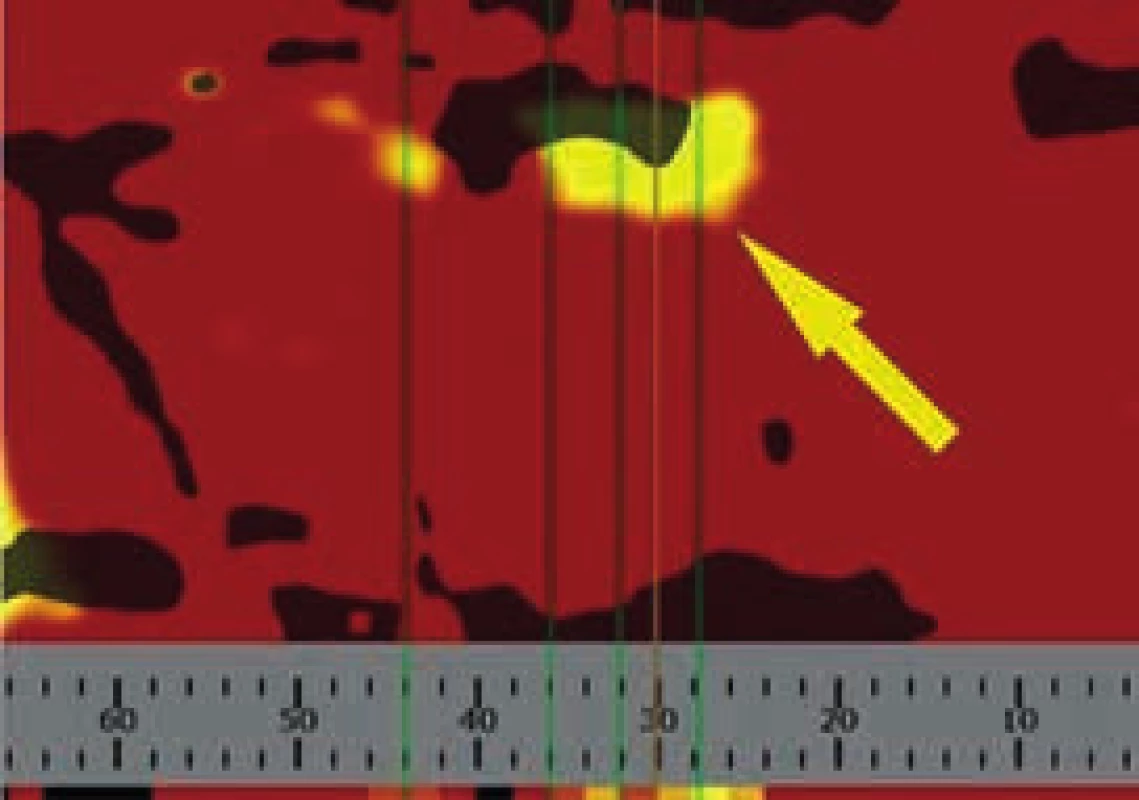 Chemogram, žlutá šipka ukazuje přítomnost lipidových částic