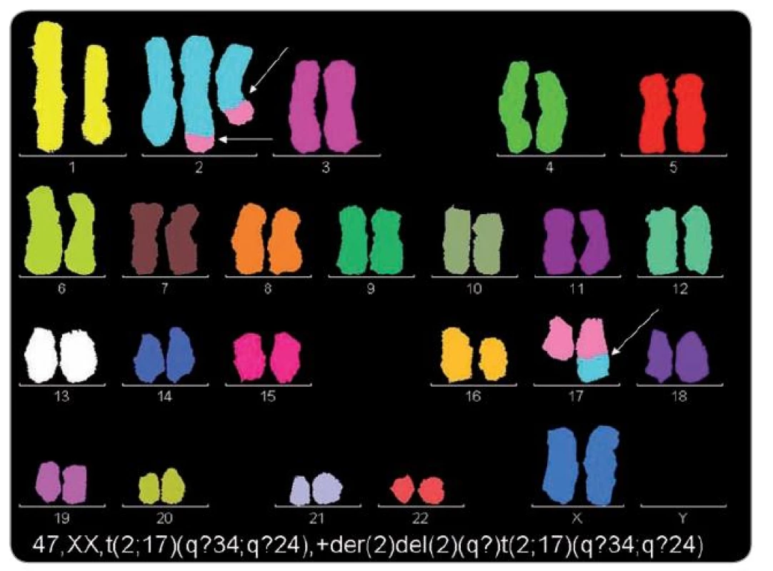 M-FISH. Pacientka s nediferencovaným sarkomem a konstituční aberací 14. chromozomu, s mentálním postižením. V karyotypu nádorových buněk byly prokázány dva klony, jeden s typickým nadbytečným chromozomem 8 a druhý s dosud nepublikovanou t(2;17)(q?34;q?24).