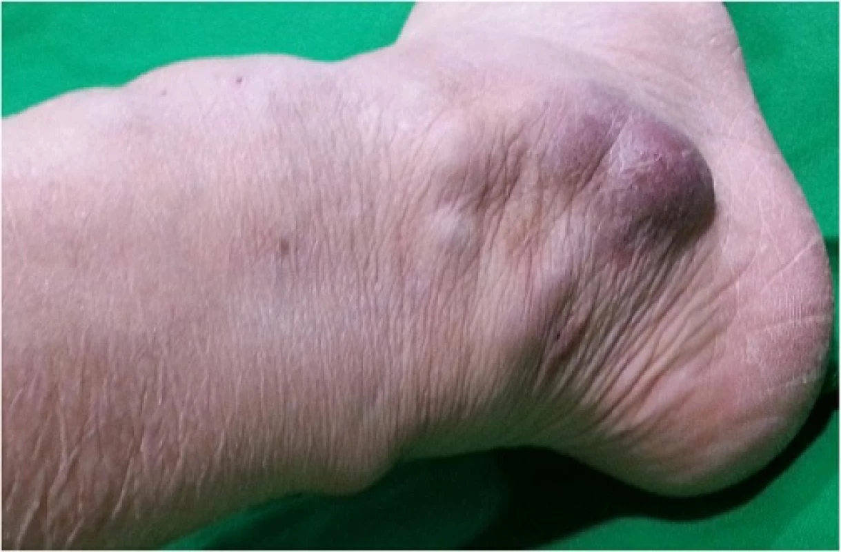 Clinical photograph of the right ankle before the operation