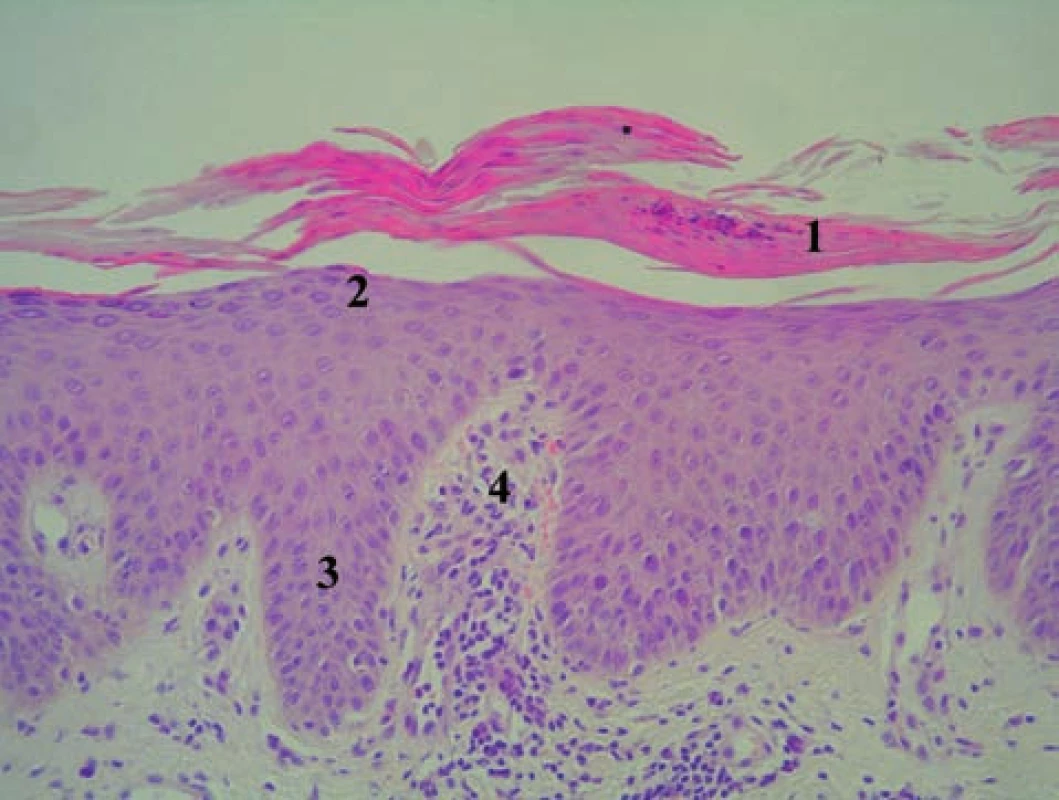 Histologický obraz včasnej lézie psoriaziformnej erupcie (viz obr. 2) u pacientky liečenej infliximabom z indikácie morbus Crohn (HE, 400 x)
1 – parakeratóza s neutrofilmi: Munroov mikroabsces, 2 – hypogranulóza až agranulóza, 3 – tvoriaca sa akantóza, 4 – papilomatóza s dilatovanou kapilárou a lymfocytovým infiltrátom