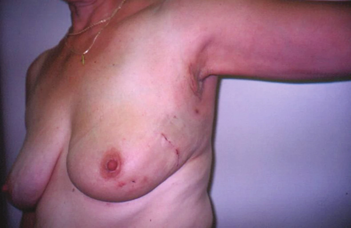 Stav po konzervativním výkonu pro karcinom prsu s biopsií sentinelové uzliny