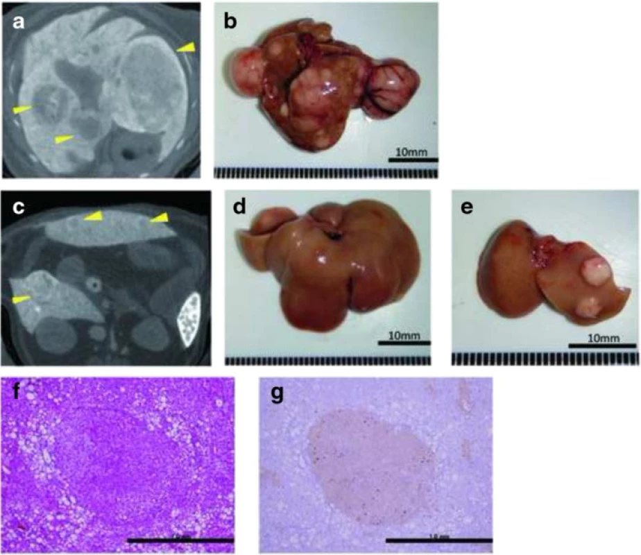 Computed tomography scans and immunohistochemistry of hepatic tumors in the high-fat, choline-deficient (HFCD) + diethylnitrosamine (DEN) group at 24 weeks: a, c computed tomography findings; b–e macroscopic views. The image in a is a section of the whole liver depicted in b; the image in c is a section of the whole liver shown in d; and the image in panel e depicts the right and left medial lobes of the whole liver in panel d. The lesions are indicated by yellow arrowheads. f Hematoxylin-eosin staining of the liver tumor. g Immunohistochemical staining for glutamine synthetase