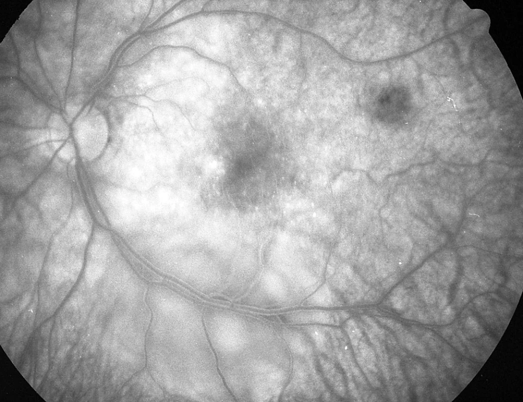 Pac. č. 2: Fluoresceínová angiografia ĽO: rozsiahla oválna ablácia neuroepitelu retiny popri dolnom temporálnom cievnom zväzku