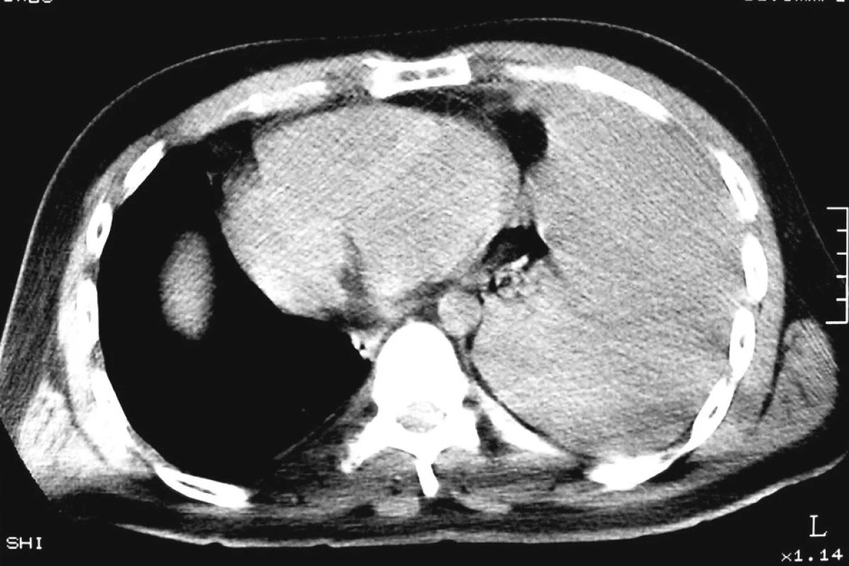 CT hrudníku, levostranný hemotorax 
Fig. 4. CT of chest, haemothorax on the left side