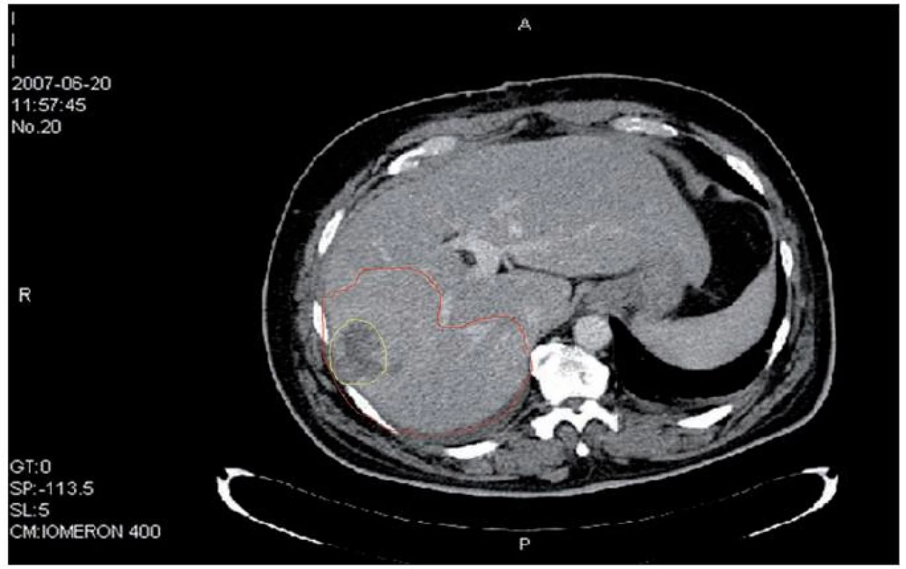 Červen 2007, červeně je vyznačen rozsah tumorózního postižení jaterního parenchymu a žlutě krvácející ložisko