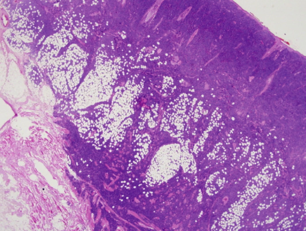Prehľad nádorovej infiltrácie dermis, subkutis a priečne pruhovanej svaloviny nádorovými bunkami (farbenie HE, zväčšenie 10x).