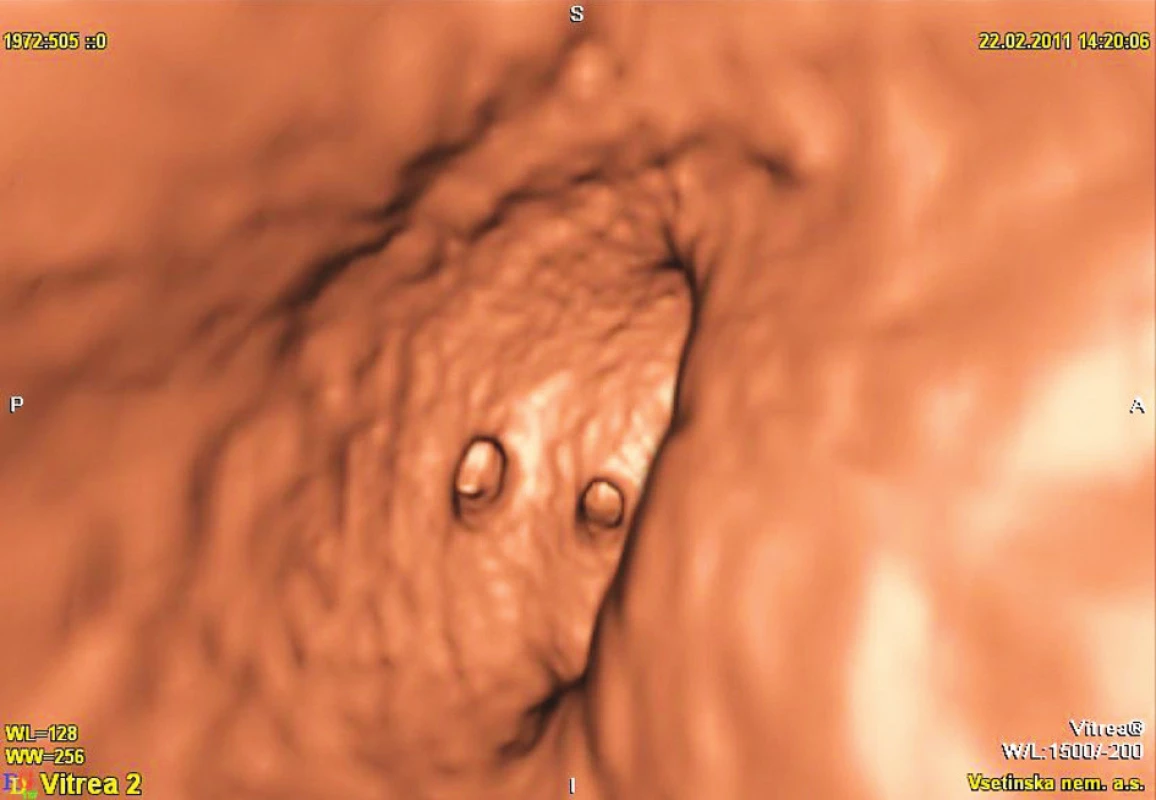Virtuální kolonoskopie
Fig. 2. Virtual colonoscopy