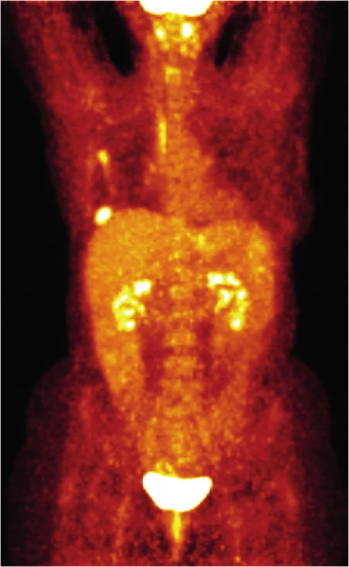 PET/CT vyšetření v dubnu 2013
Fig. 6: PET/CT scan in April 2013