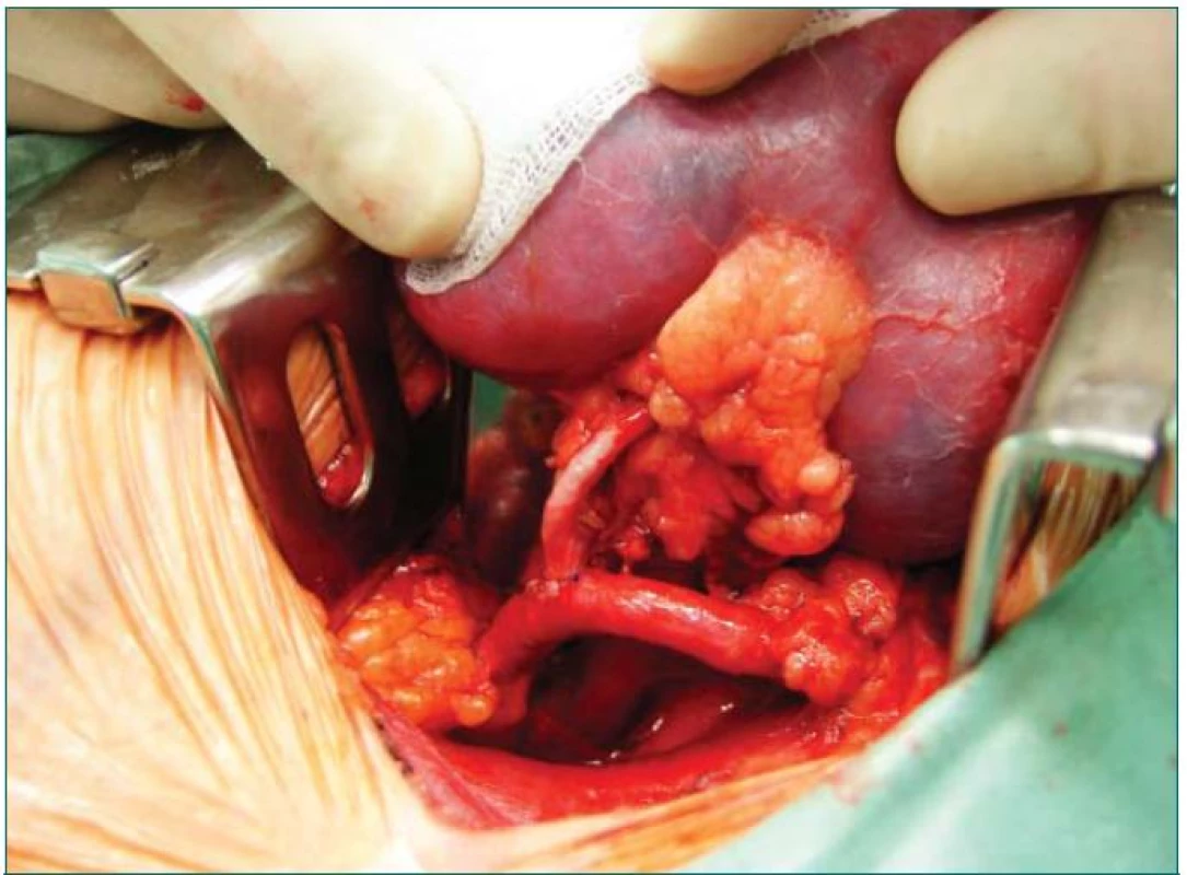 Obnovený oběh v ledvině (anastomóza renálních cév na příjemcovy zevní ilické cévy).