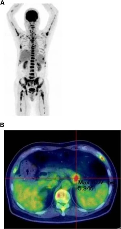 PET-CT studies. a: Diffuse skeletal uptake; b: Abnormal uptake in the tail of the pancreas