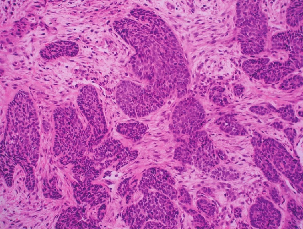 Prekancerózní léze vulvy a dlaždicobuněčné karcinomy asociované s HPV infekcí.
A – u-VIN III, warty (HE, 40x); B – u-VIN III, warty (HE, 400x); C – SCC, warty (HE, 200x); D – u-VIN III, bazaloidní (HE, 100x); E – u-VIN III, bazaloidní (HE, 400x); F – SCC, bazaloidní (HE, 100x)