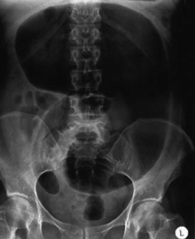 Nativní snímek břicha s dilatací a pneumatózou kličky tlustého střeva