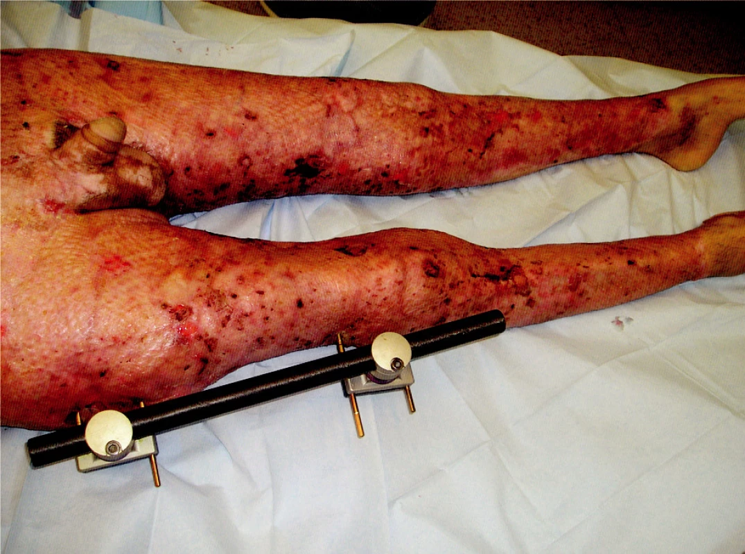 Healed transplanted areas on trunk and right lower extremity, transplanted and harvest areas on the right upper extremity