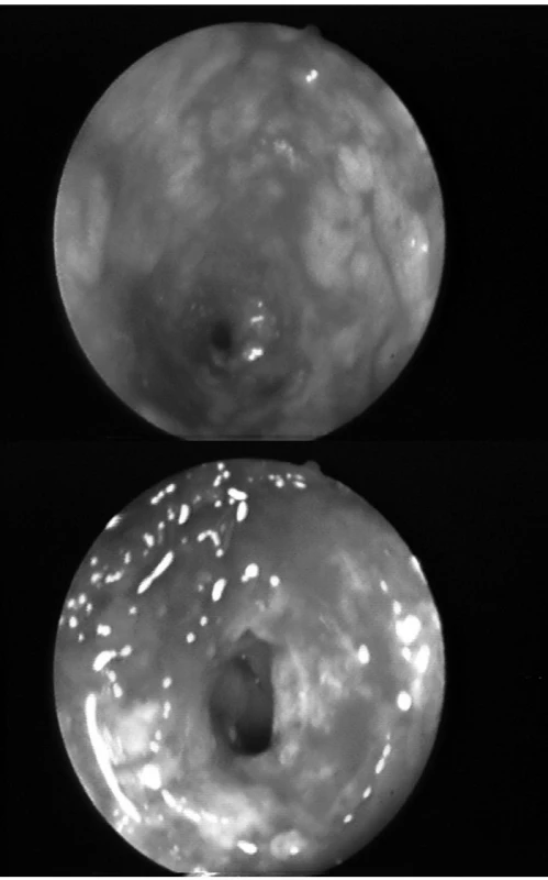 a, b. Endoskopický nález. Pohled do těsné stenózy rektosigmoideálního přechodu, ulcerace,
krvácení.
Fig. 1a, b. Endoscopic finding. A view of narrow stenosis of rectosigmoid transition, ulceration, bleeding.