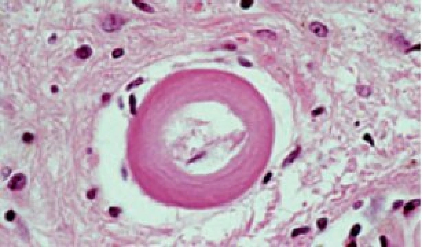 Lipohyalinóza (neboli arterioloskleróza, small vesel disease, mikroangiopatie). Cerebrální amyloidovou angiopatie odliší speciální barvení nebo imunohistochemická reakce. (Zv. x 200, barvení H.E).