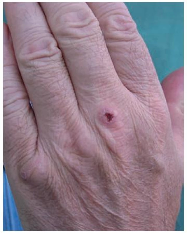 Klinický nález na dorzu levé ruky v září 2009