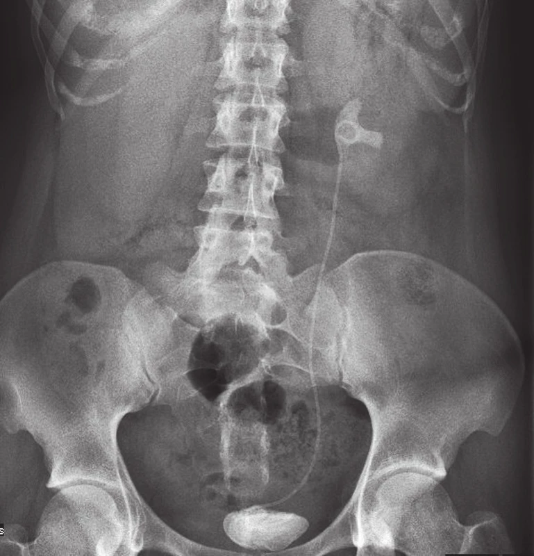 Nefrogram – inkrustovaný proximální i distální konec stentu v levé ledvině
Fig. 1. Plain-film radiography – incrusted proximal and distal part of the stent in left kidney