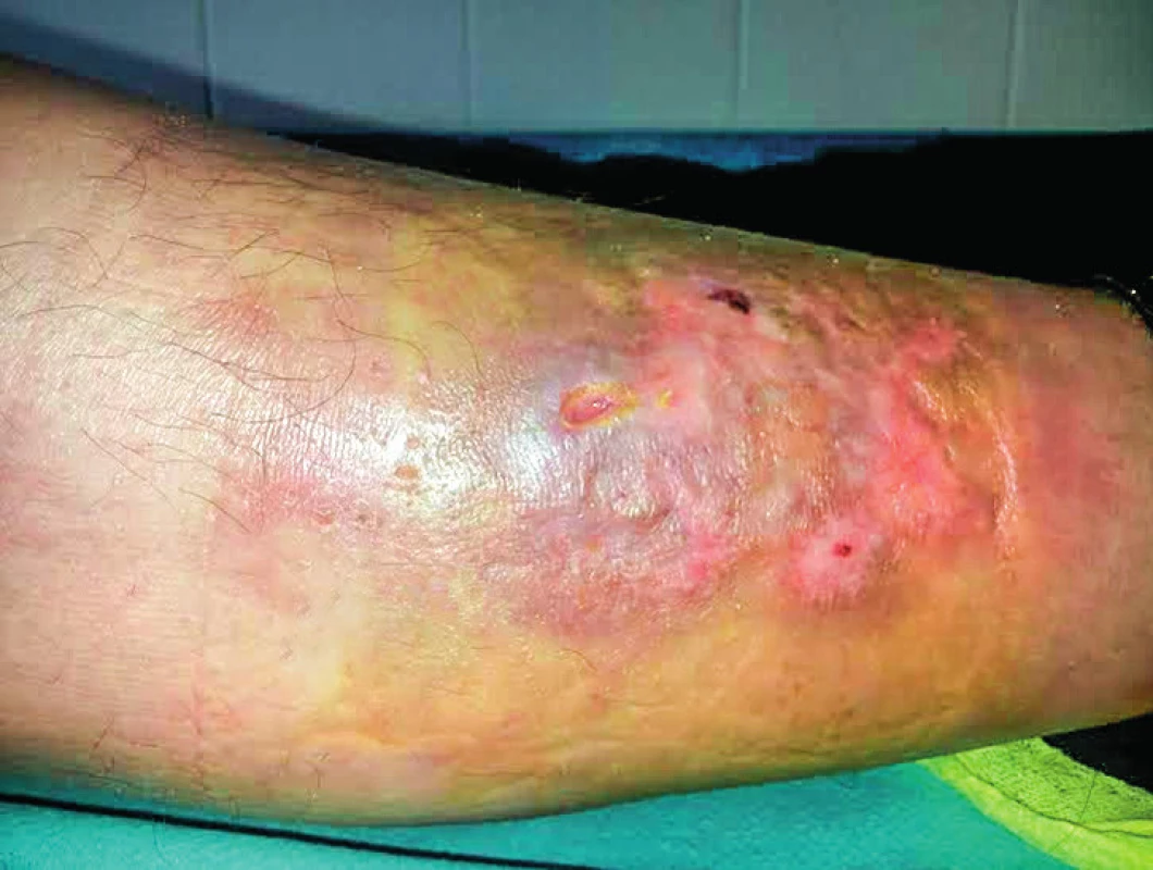 Necrobiosis lipoidica – nežiaduci účinok na koži predkolenia, ktorý vznikol v priebehu liečby IFN-α u 52-ročnej pacientky s polycytémiou vera