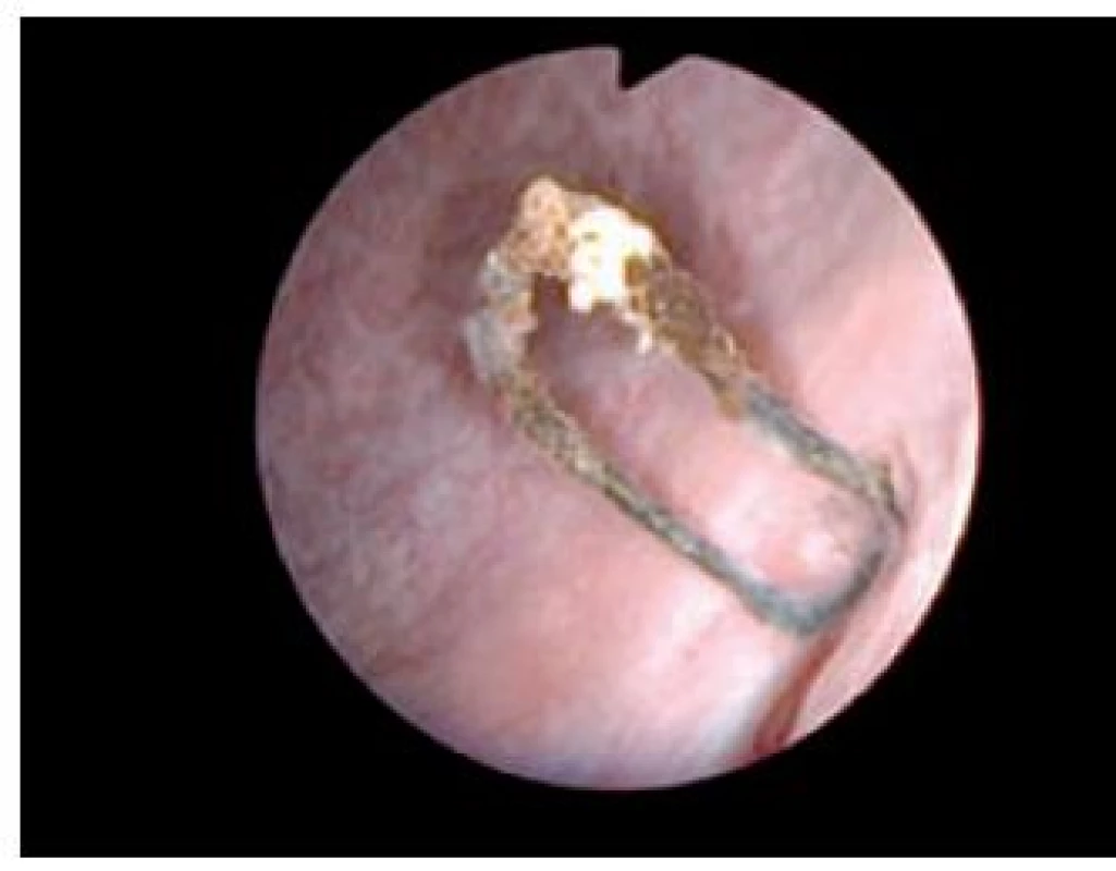 Kazuistika 2 – endoskopie: inkrustovaný steh ve stěně močového měchýře
Fig. 5 Case report 2 – endoscopy: incrustated stitch in urinary bladder