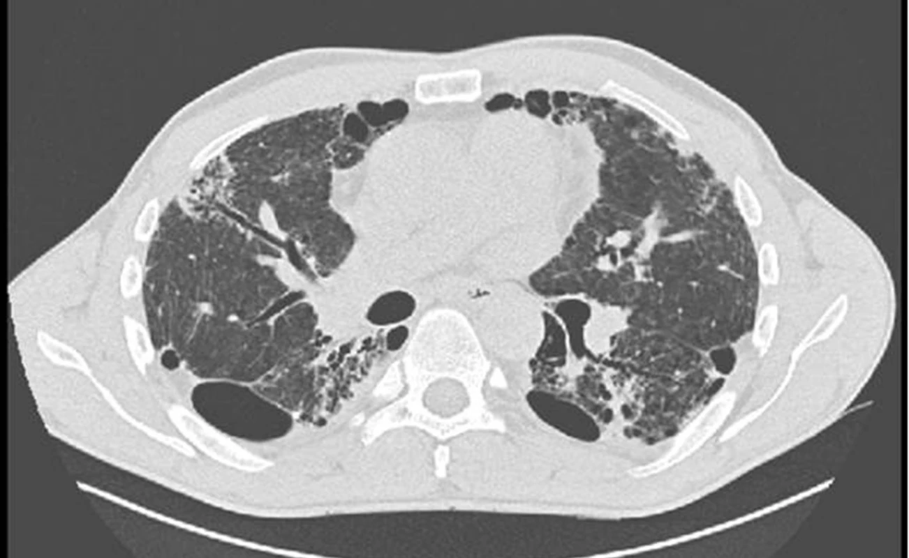 HRCT obraz bronchiektázií u nemocného s intersticiálním plicním procesem