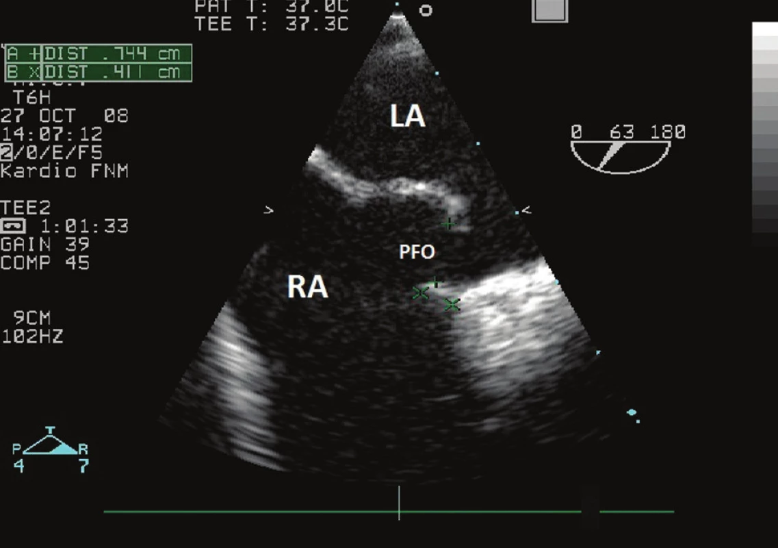 Jícnová echokardiografie (Pohled v krátké příčné ose na mezisíňovou přepážku s patrným PFO a průnikem kontrastní látky do levé síně při Valsalvově manévru. Změřena šíře otevření (0,744 cm). LA – levá síň, RA – pravá síň, PFO – foramen ovale patens.)
Fig. 1: Transesophageal echocardiography (Short-axis view of the interatrial septum. Contrast agent penetration through PFO into the left atrium during the Valsalva maneuver. The width of PFO opening was measured (0.744 cm). LA – left atrium, RA – right atrium, PFO – patent foramen ovale.)