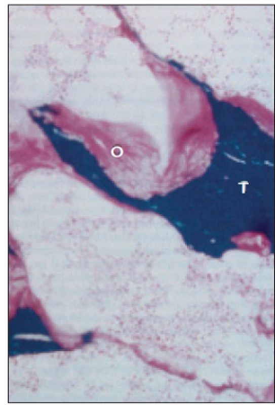 Histologický nález při osteomalacii. Kostní trámce (T) obklopuje nemineralizovaná nově tvořená kost – osteoid (O).