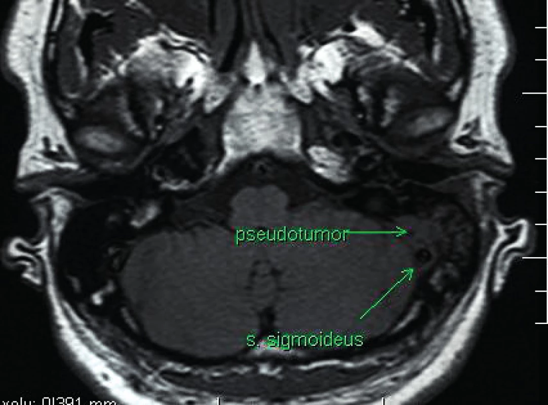 MRI axiální koronární zobrazení pseudotumoru levé pyramidy (T1 sken).