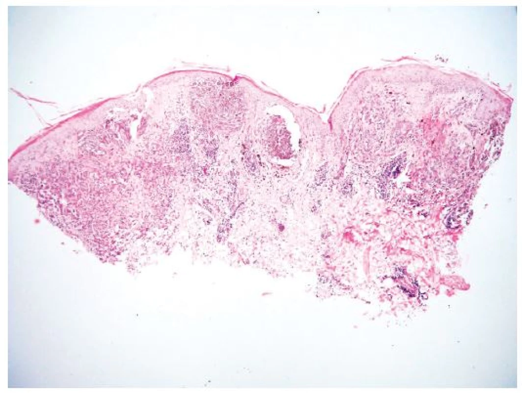 Histologický obraz z probatorní excize
V centru dvě velká hnízda pigmentovaných melanocytů a celkově nesouměrná architektura léze jsou při malém zvětšení znaky svědčící pro možnou malignitu (původní zvětšení 40x).