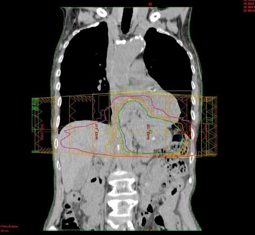 Distribuce dávky při paliativní radioterapii žaludku technikou IMRT.