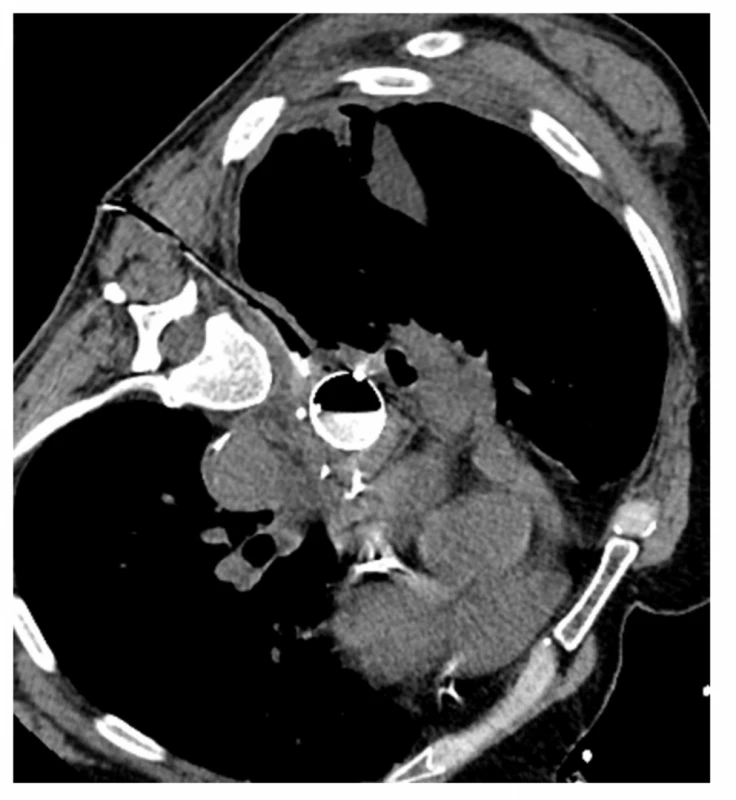 CT navigovaná drenáž mediastinálního abscesu,
v jícnu stent<br>
Fig. 6: CT guided drainage of mediastinal abscess, stent
in the esophagus