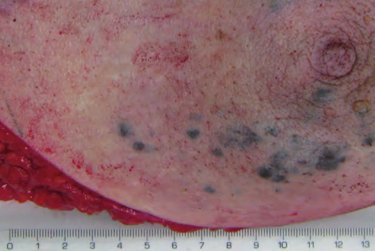 Kůže prsu s prosvítajícími ložisky metastatického melanomu.