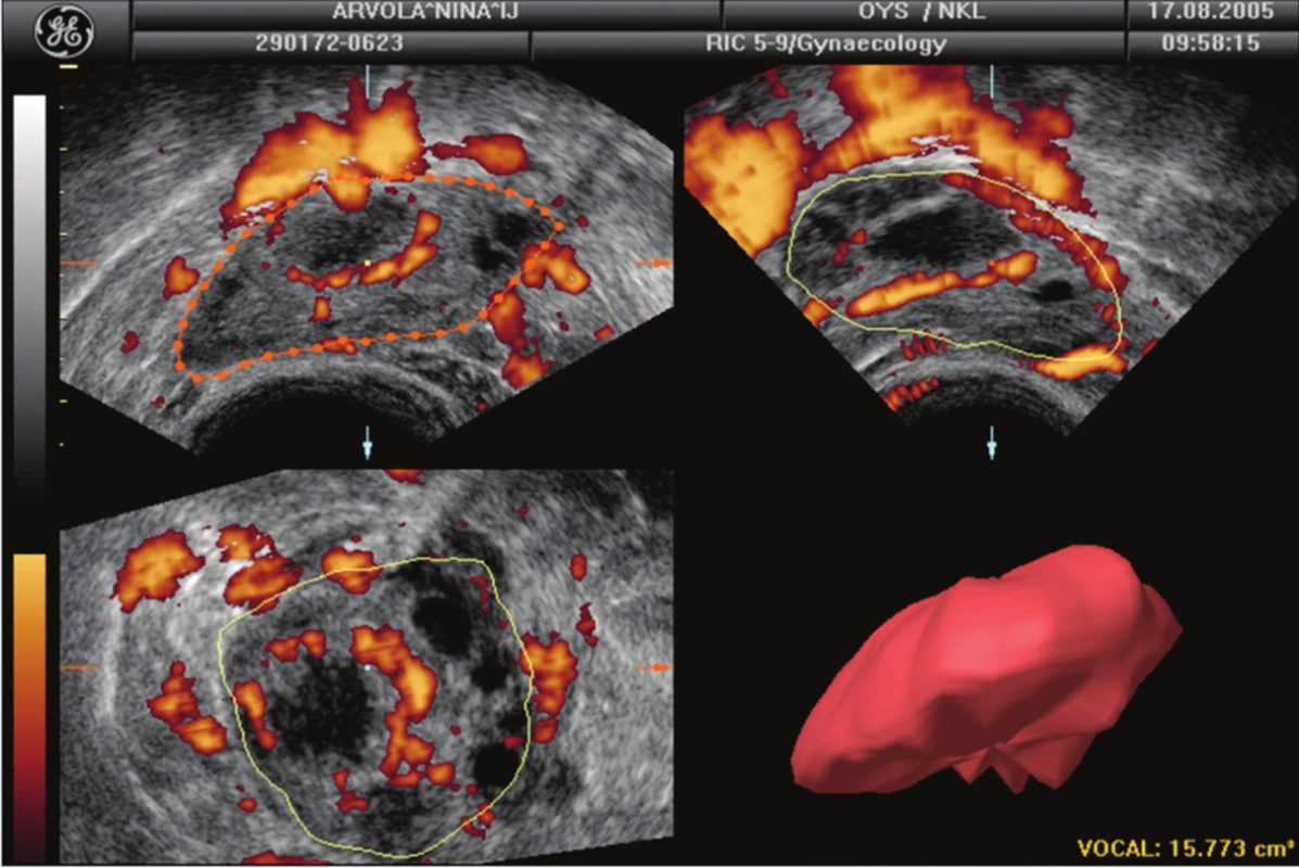 Objem dominantního ovaria s funkčním žlutým tělískem při zobrazení pomocí program VOCAL