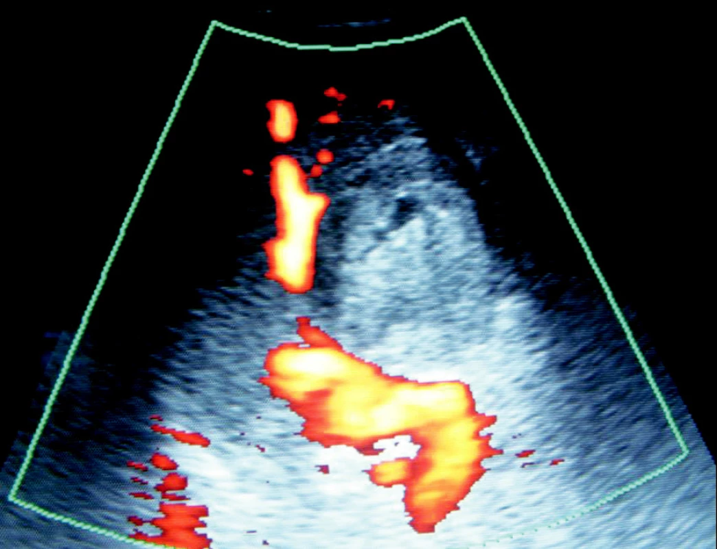 Ultrasonografický obraz trombózovaného pseudo-aneuryzmatu tepny v oblasti kaudy pankreatu
Fig. 4. Ultrasound view of the thrombotized arterial pseudoaneurysm within the pancreatic cauda