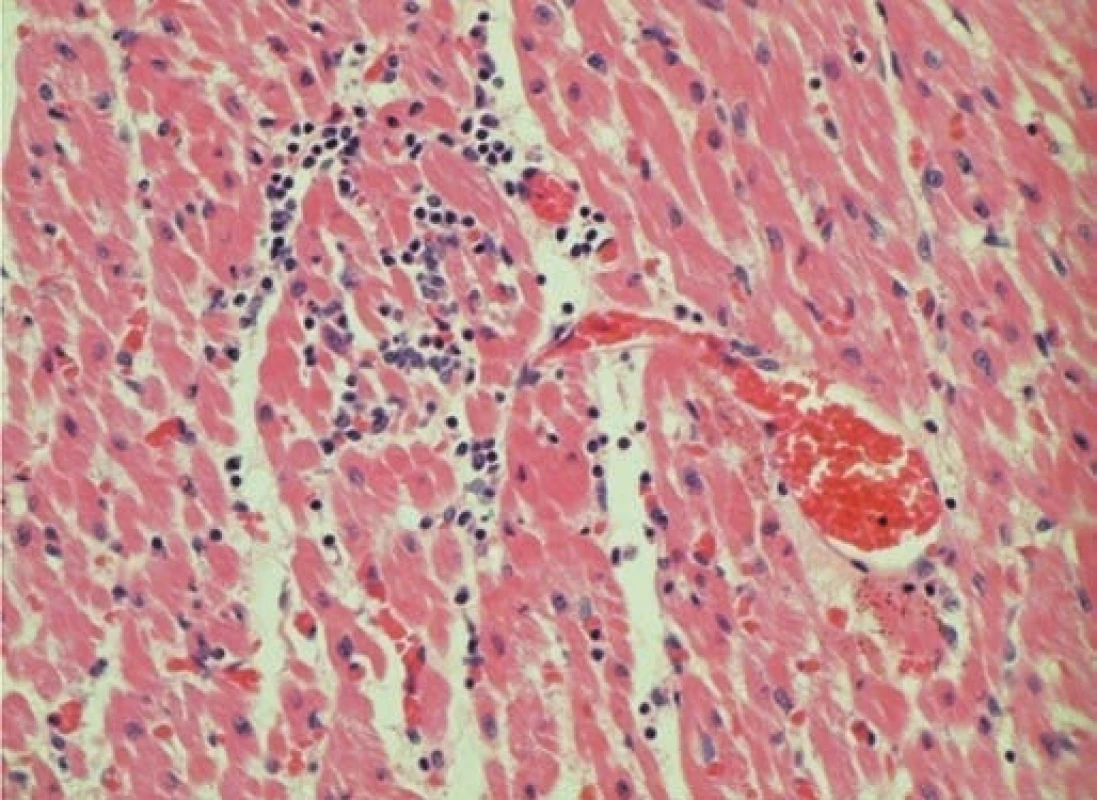Histologický nález tkáně myokardu u pacienta č. 3.
Fig. 5. Histological finding of myocardial tissue in patient No. 3.