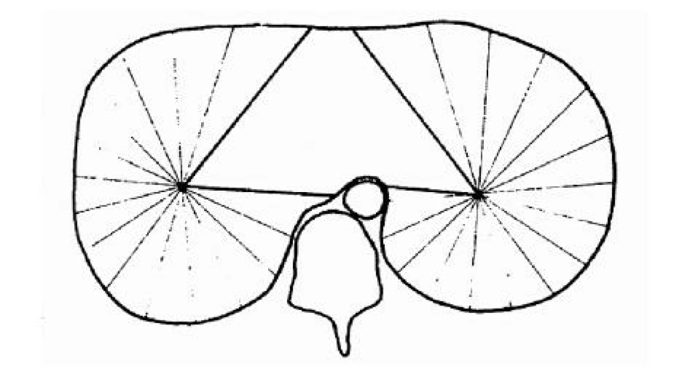 Schematické zobrazení iradiace svalových vláken z center jednotlivých bráničních kopulí s existencí centrálního triangulárního prostoru, dle Whitelawy rekonstrukce tomografického záznamu (Whitelaw, 1987).
