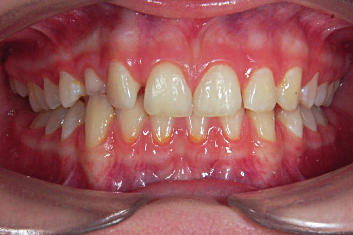 Asymetrie v prořezávání horních špičáků mezi pravou a levou stranou zubního oblouku